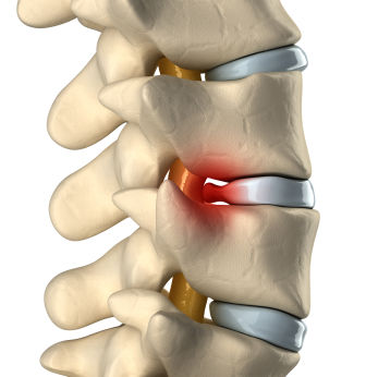 Posições que afetam a coluna e comprometem os discos vertebrais causando dor